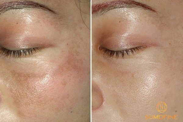 Nám da hỗn hợp sau bao lâu thì khỏi