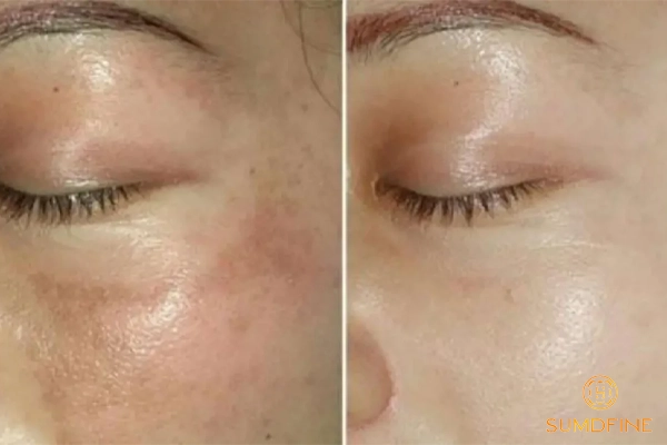 Điều trị nám trung bì bằng kem bôi trị nám