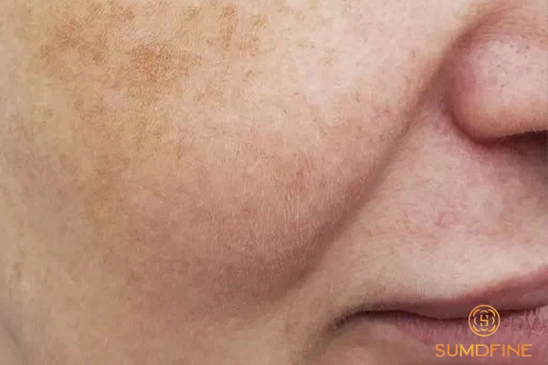 Tại sao vitamin e có thể hỗ trợ giảm nám da