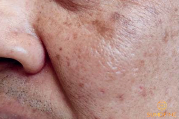 Cách trị nám da ở nam giới