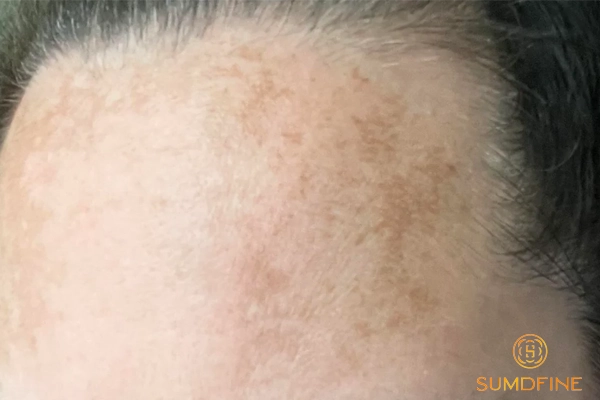 Da bị nám nhẹ: Nguyên nhân, dấu hiệu và 6 cách điều trị hiệu quả nhất 4 Nám nhẹ có tự hết được không?