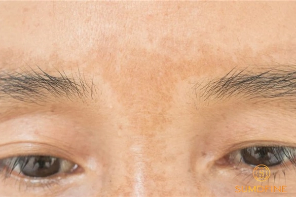 Da bị nám nhẹ: Nguyên nhân, dấu hiệu và 6 cách điều trị hiệu quả nhất 2 Da bị nám nhẹ trông như thế nào