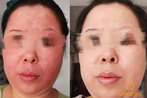 Sau peel da bao lâu thì da phục hồi