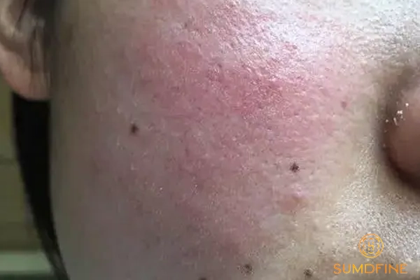 Da sau peel trải qua quá trình gì