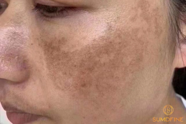 Dấu hiệu nhận biết của nám nội tiết