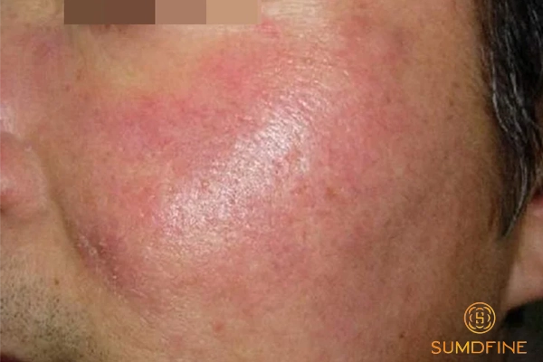 Da bị dị ứng mỹ phẩm