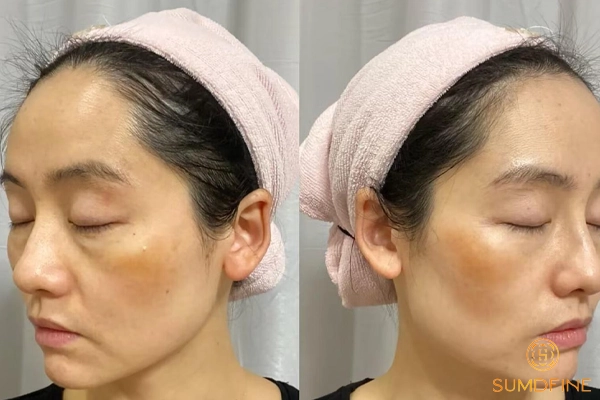 Điều trị nám nội tiết bằng thuốc