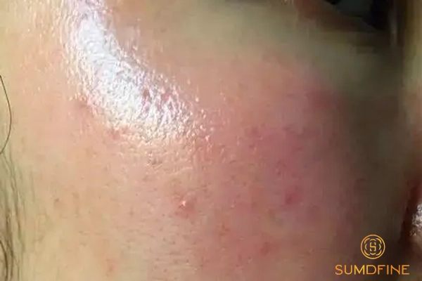 Hậu quả khi không phục hồi da sau peel đúng cách