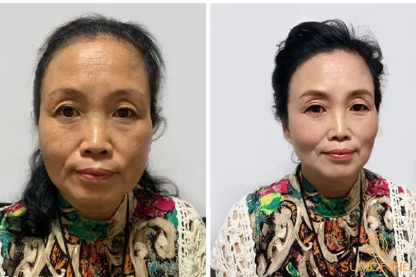 Trước và sau khi dùng kem trị nám Sumdfine