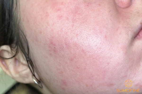 Serum B5 kết hợp với kem dưỡng nào? Gợi ý 4 lựa chọn tối ưu 2 Kem dưỡng Madecassoside