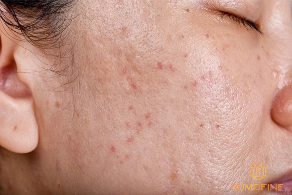 Lỡ cạy vảy mụn