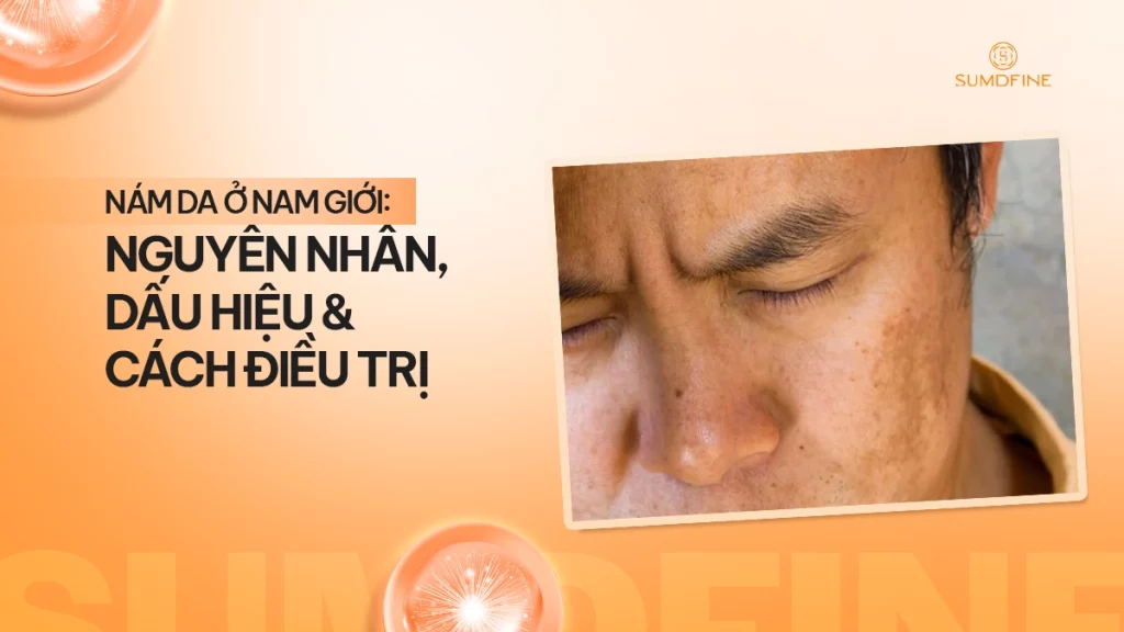 Nám da ở nam