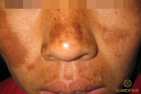 Tìm hiểu về nám da ở nam giới