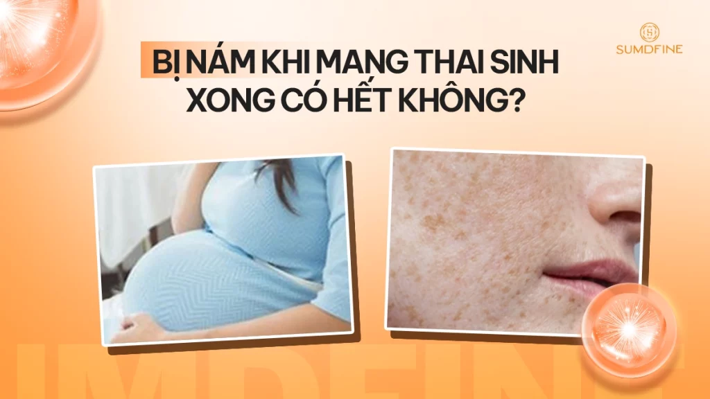 Nám khi mang thai sau sinh có tự hết?