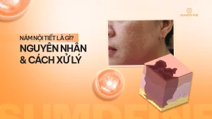 Nám nội tiết là gì?