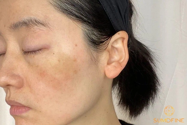 Nám nội tiết là gì?