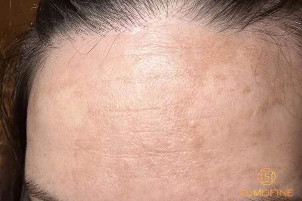 Da bị nám nhẹ: Nguyên nhân, dấu hiệu và 6 cách điều trị hiệu quả nhất 3 Nguyên nhân khiến da bị nám nhẹ