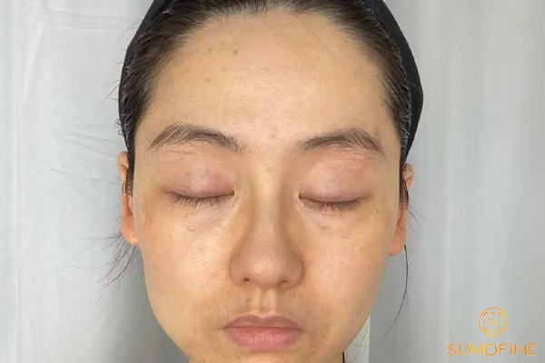 Nguyên nhân gây nám nội tiết trong độ tuổi 20 - 30