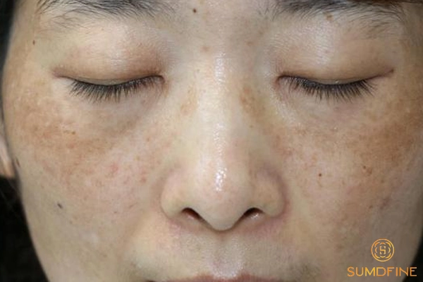 Vì sao nam giới bị nám da