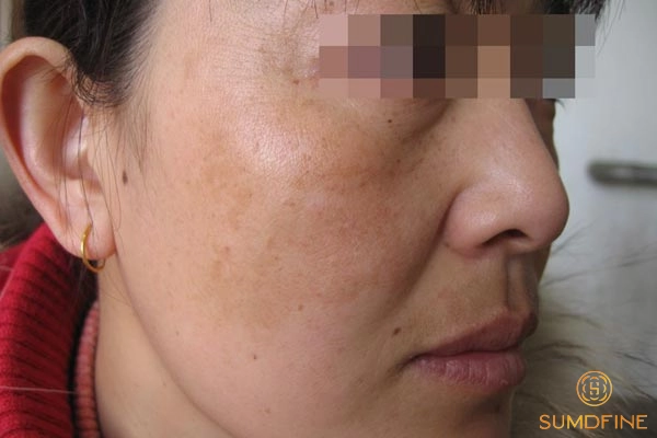 Nám nội tiết trong độ tuổi 30 - 40