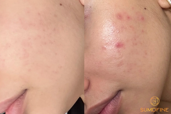 Serum B5 kết hợp với kem dưỡng nào? Gợi ý 4 lựa chọn tối ưu 1 Kem dưỡng Niacinamide