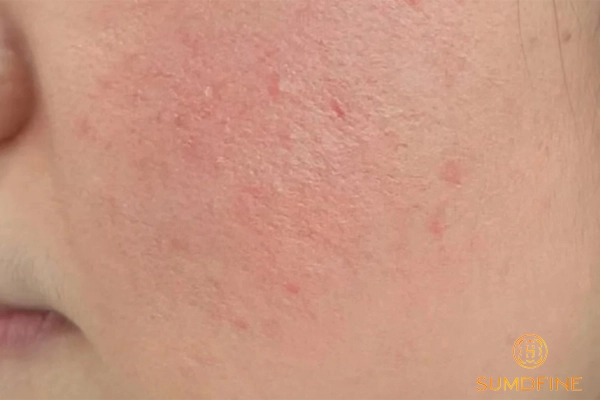 Patch test trước khi dùng retinol