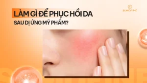 9 Cách phục hồi da bị dị ứng mỹ phẩm an toàn, hiệu quả ít ai biết 4 Cách phục hồi da dị ứng mỹ phẩm