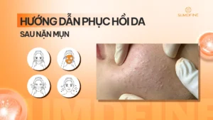 Phục hồi da sau nặn mụn: Làm gì ngay để không thâm sẹo? 5 Hướng dẫn phục hồi da sau nặn mụn