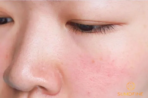 Sau khi peel da nên kiêng gì?