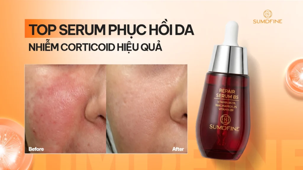 TOP serum phục hồi da nhiễm corticoid hiệu quả