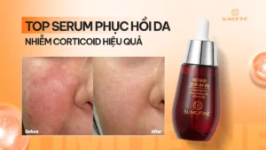 TOP serum phục hồi da nhiễm corticoid hiệu quả