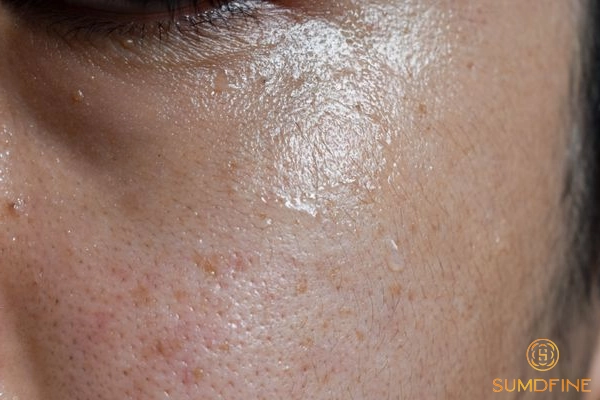 Skincare cho nam giới bị nám