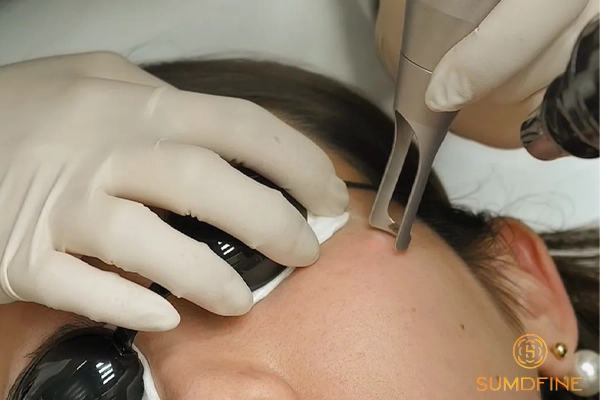 Da bị nám nhẹ: Nguyên nhân, dấu hiệu và 6 cách điều trị hiệu quả nhất 5 Trị nám nhẹ bằng laser