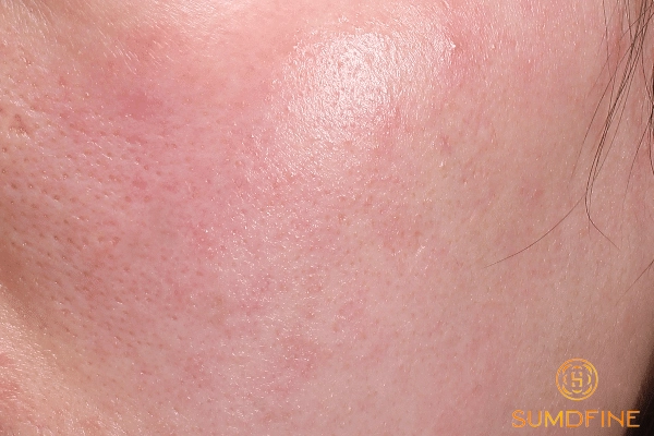 Lý do bôi serum B5 bị rát mặt và cách xử lý từng bước 4 Bôi serum B5 bị rát mặt có nguy hiểm không?