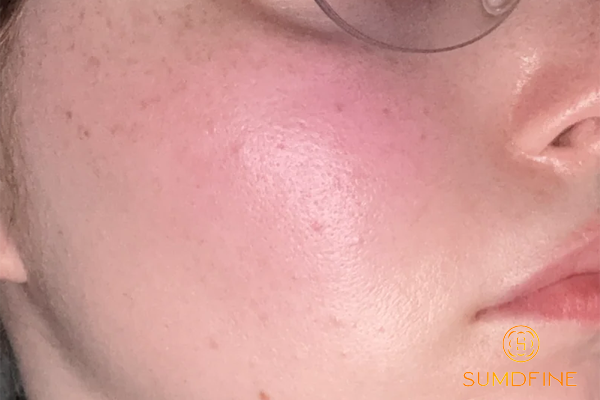 Top 5 Serum B5 Phục Hồi Da Sau Lăn Kim 2026 Bác Sĩ Da Liễu Khuyên Dùng 2 Phục hồi da sau lăn kim với serum b5