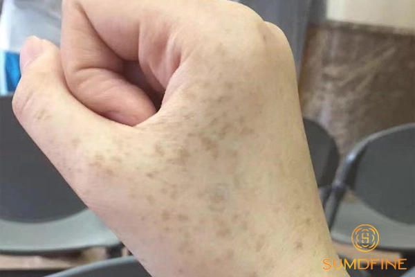 Nhận diện và xử lý nám da tay hiệu quả tại nhà & tại phòng khám 2 Da tay bị nám