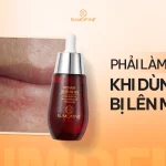 Tại sao dùng serum B5 lại bị lên mụn thay vì phục hồi da?