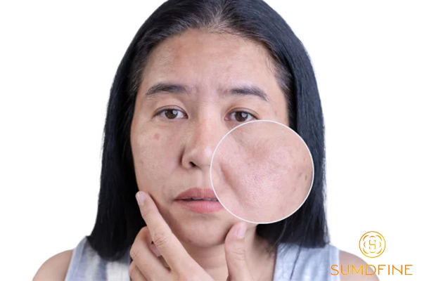 12 Cách trị nám tại nhà hiệu quả không cần ra spa, không cần laser 6 Sử dụng hoạt chất để trị nám tại nhà