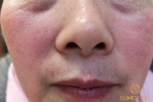 Lý do bôi serum B5 bị rát mặt và cách xử lý từng bước 5 Trường hợp cần đến khám bác sĩ da liễu