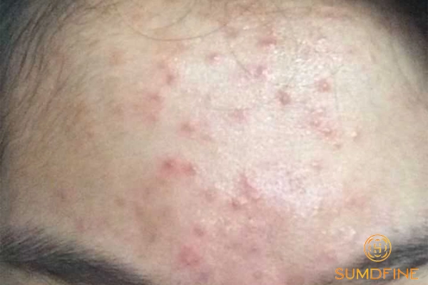 Lý do dùng b5 xong bị nổi mụn