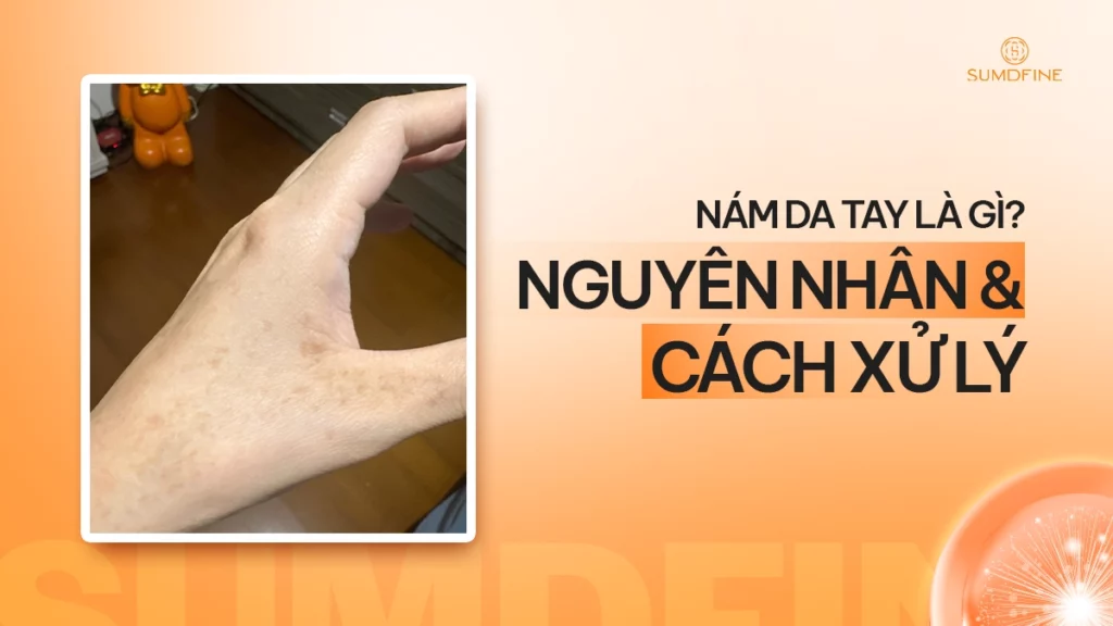 Nhận diện và xử lý nám da tay hiệu quả tại nhà & tại phòng khám 1 Nám da tay là gì?