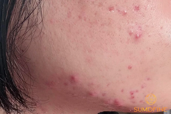 Nguyên nhân dùng serum b5 bị đẩy mụn