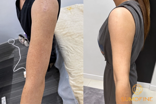 Nhận diện và xử lý nám da tay hiệu quả tại nhà & tại phòng khám 3 Những nguyên nhân gây nám da tay