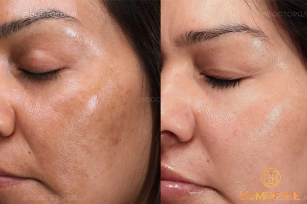 Niacinamide - hoạt chất hỗ trợ điều trị nám chân sâu