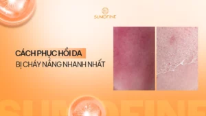 Kinh nghiệm phục hồi da bị cháy nắng hiệu quả, giảm đỏ rát bong tróc 4 Cách phục hồi da bị cháy nắng