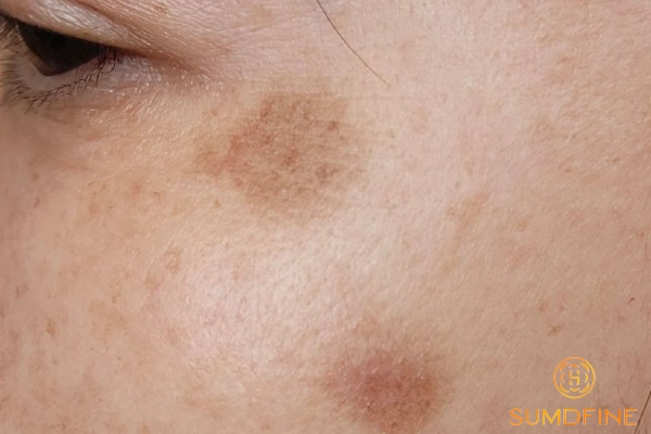 12 Cách trị nám tại nhà hiệu quả không cần ra spa, không cần laser 2 Tìm hiểu về nám da