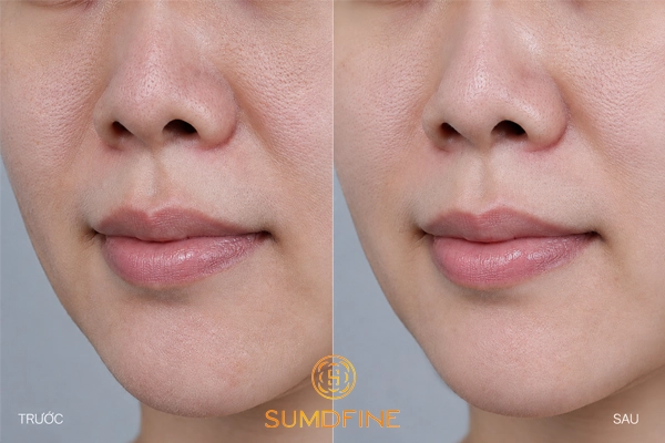 Serum hàn quốc Anua cho da khô - review hiệu quả