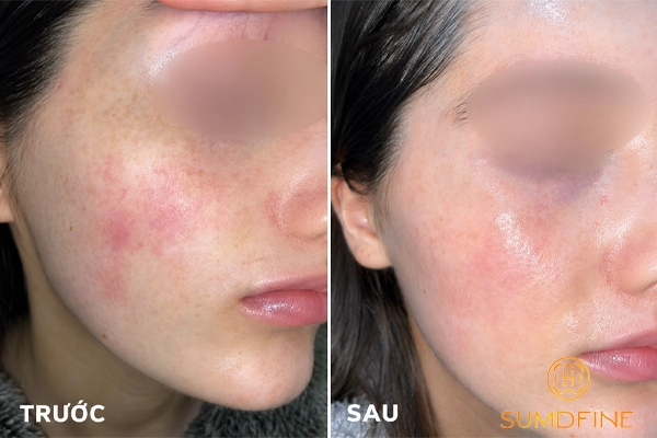 Review kem trị nám Eucerin có hiệu quả thật không?