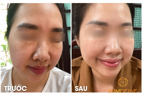 Transino Whitening-Repair Cream EX - review kem trị nám đáng dùng