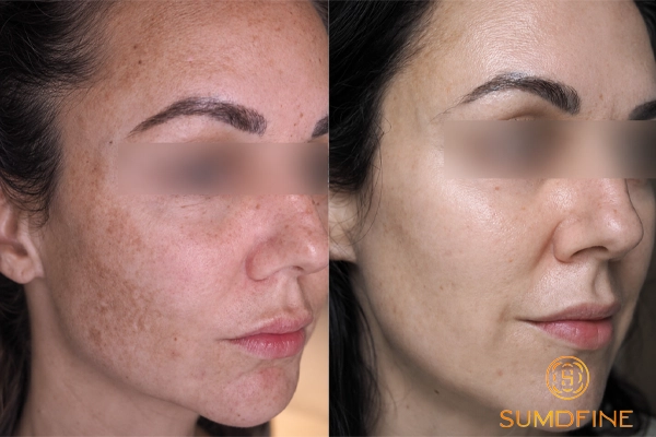 Kem trị nám Tri-Luma có hiệu quả không?